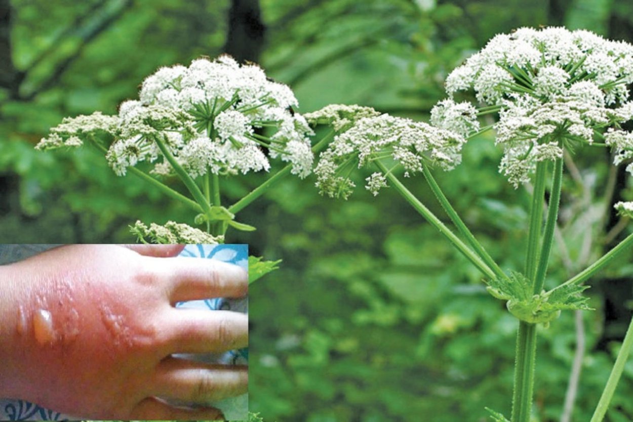 Борщевик ядовитое растение ожоги