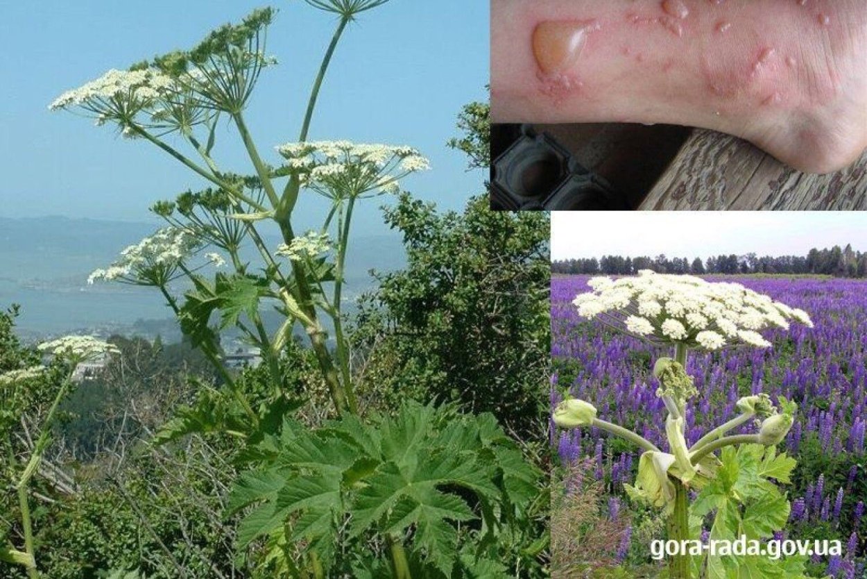 Борщевик Сосновский ожоги